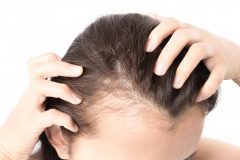 Menopause and the dreaded hair loss!